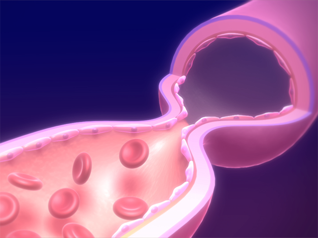 血管の異常収縮のメカニズム