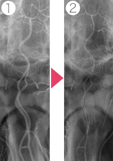 PC投与2時間後の血管